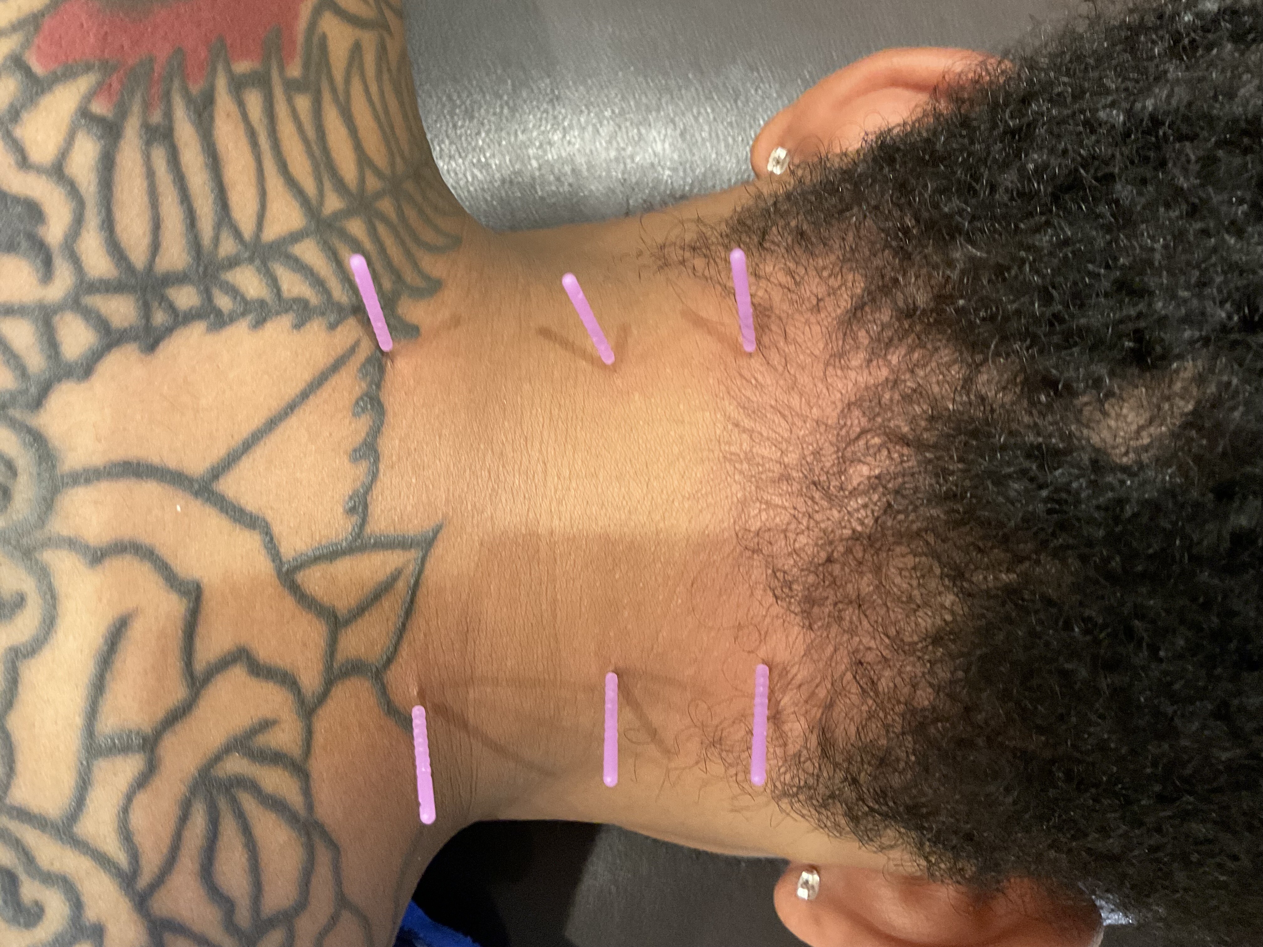 Dry Needling Physical Therapy