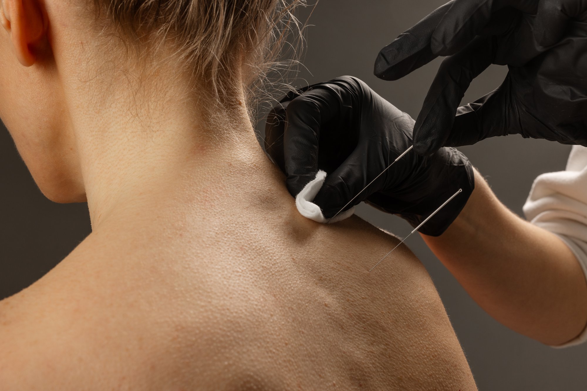 close-up-of-dry-needling-acupuncture-procedure-on-2025-04-01-19-53-32-utc